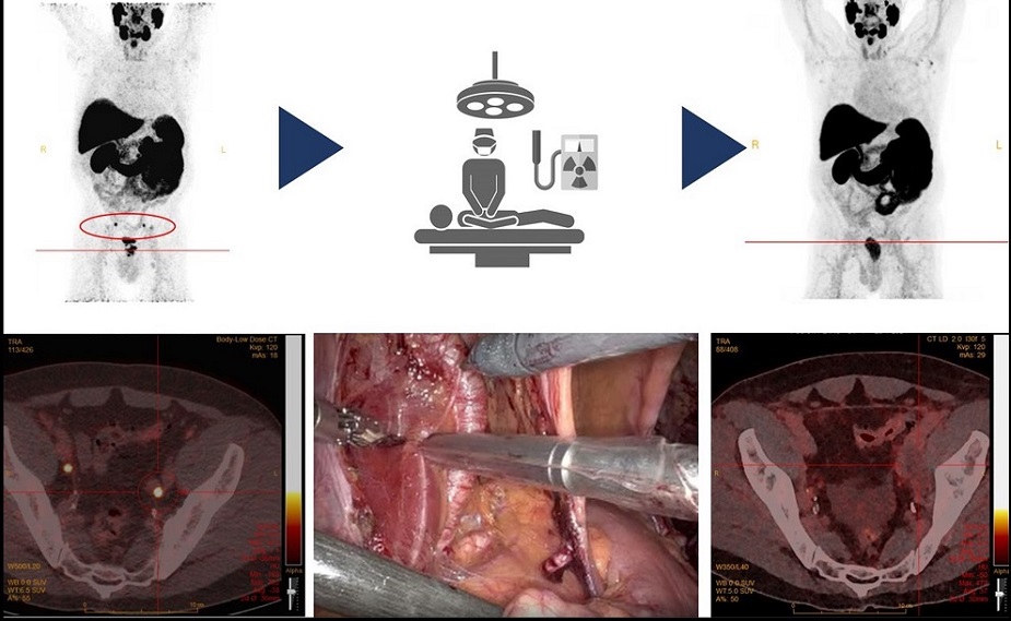Imagen: Imágenes preoperatorias y postoperatorias de PSMA-PET/CT que muestran la extirpación de ganglios linfáticos pélvicos positivos en el procedimiento quirúrgico radioguiado (Fotografía cortesía de M.G.M. Schilham)
